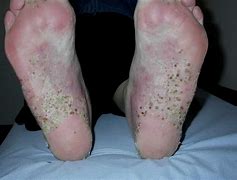 Image result for Pustule Skin Lesion