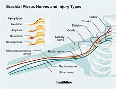 Image result for Brachial Plexus Fall Injury