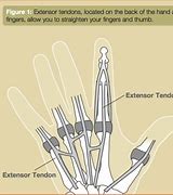 Image result for Thumb Extensor Tendonitis