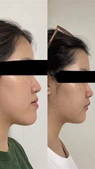 Image result for Recessed Chin Surgery