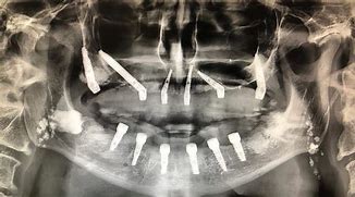 Image result for Peri Zygomatic