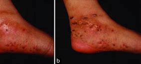 Image result for Actinomycetoma