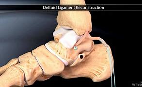 Image result for Deltoid Ligament Repair