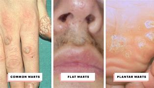 Image result for Flat Skin Warts