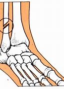 Image result for Ankle Fracture Clip Art