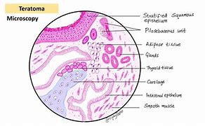 Image result for Teratoma