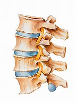 Image result for Lumbar Spine Herniation