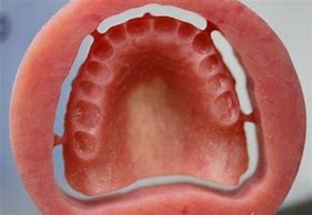 Image result for CAD/CAM Dentures