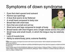 Image result for Severe Down Syndrome