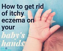 Image result for Baby Eczema Hands