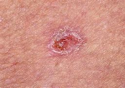 Image result for Basal Cell Carcinoma Lesions