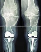 Image result for Left Knee Arthroplasty