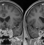 Image result for Aneurysm in MRI