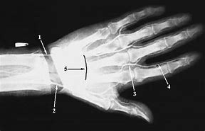 Image result for Hand Angiogram