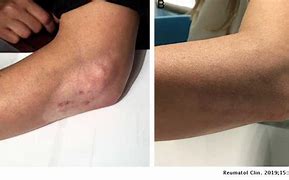 Image result for Atrophy From Steroid Injection