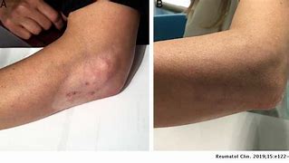 Image result for De Qinjection Atrophy Skin