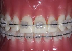 Image result for Fixed Braces Teeth Side View