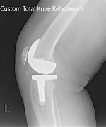 Image result for Left Knee Arthroplasty