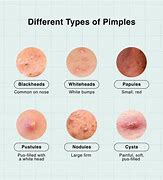 Image result for Pustules On Forehead