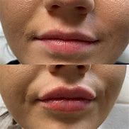 Image result for Versa Lip Filler