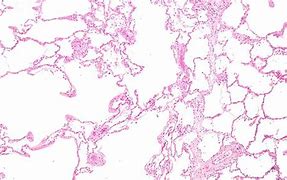 Image result for Distal Acinar Emphysema