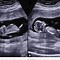 Image result for Anencephaly Ultrasound