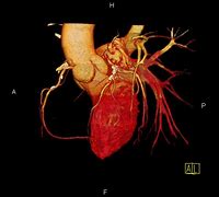 Image result for Angio CT Artere Coronare