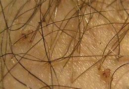 Image result for Crabs Skin Disease