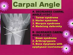 Image result for Carpal Angle