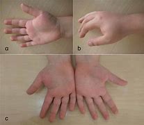 Image result for Dorsal Thenar Eminence