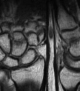 Image result for Capitate Sagittal Imaging