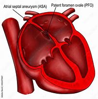 Image result for Septal Aneurysm