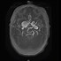 Image result for Aneurysm in MRI