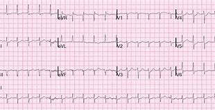 Image result for Atrial Fibrillation 12 Lead ECG