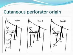 Image result for Anterolateral Thigh Flap