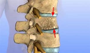 Image result for Imagees Compression Fracture of Lumbar Vertebrae