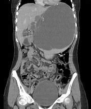 Image result for Cyst On Spleen