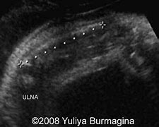 Image result for Achondroplasia X-ray