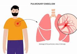 Image result for Pulmonary Embolism Post-Mortem Changes