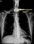 Image result for Esophageal Sphincter Spasm