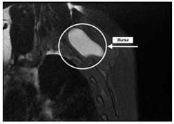 Image result for Scapulothoracic Bursitis MRI