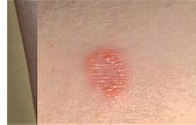 Image result for Candida Skin Rash Symptoms