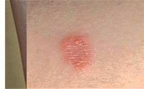 Image result for Candida Rash