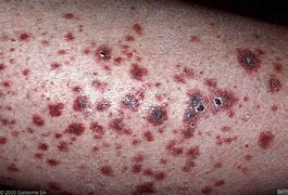 Image result for Vasculitis Leg Ulcers