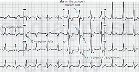 Image result for Atrioventricular Reciprocating Tachycardia