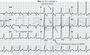 Image result for Atrioventricular Reciprocating Tachycardia