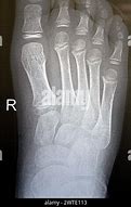 Image result for Thumb X-ray Child