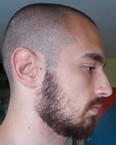 Image result for Weak Cheek Beard