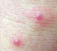 Image result for Bird Nest Mites