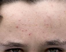 Image result for Subclinical Acne